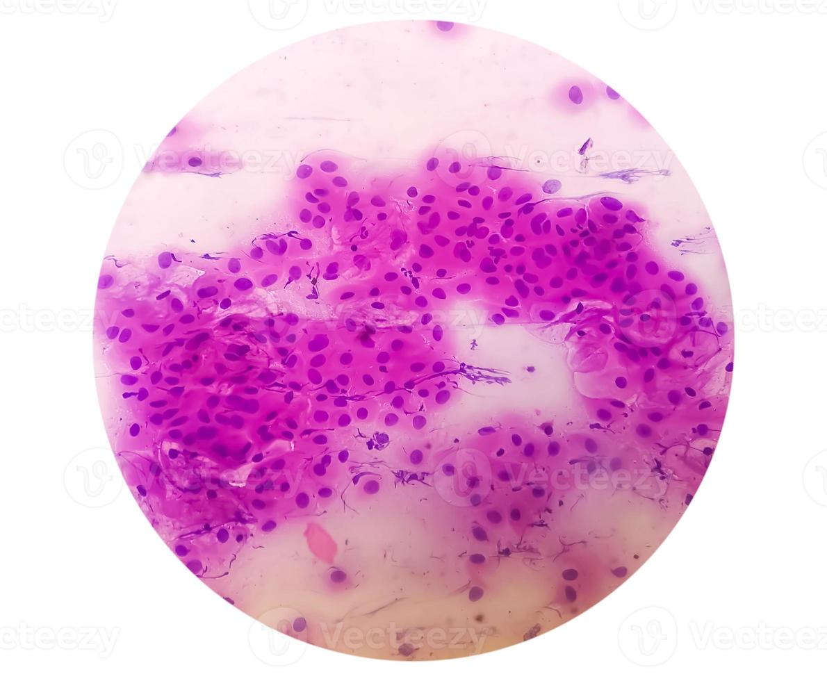 Pap's smear pap stain Microscopic 40x Zoom show High-grade squamous intraepithelial lesion is a pre-cancerous, sexually transmitted disease photo