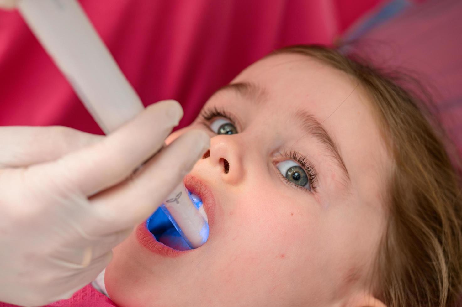 Ultraviolet light in dentistry, the dentist holds a device with ultraviolet light to quickly seal the filling in the child's tooth. photo