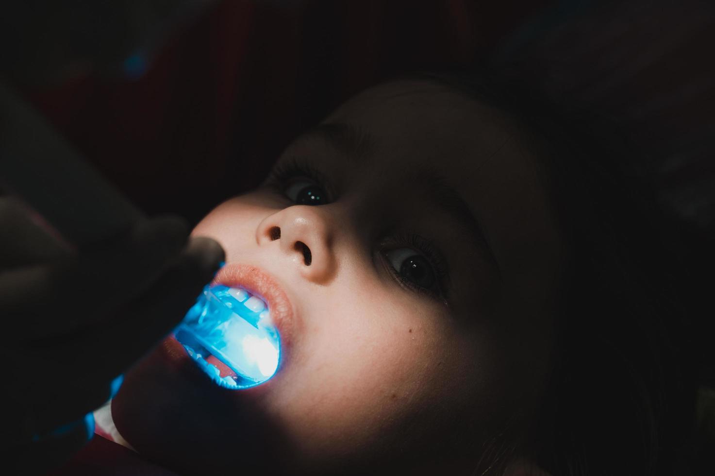 Ultraviolet light in dentistry, the dentist holds a device with ultraviolet light to quickly seal the filling in the child's tooth. photo