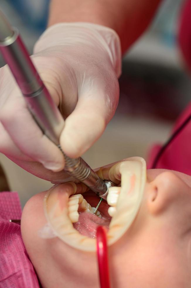 el dentista limpia la caries dental en un niño con un taladro, en la saliva eyectora de la boca del niño. foto