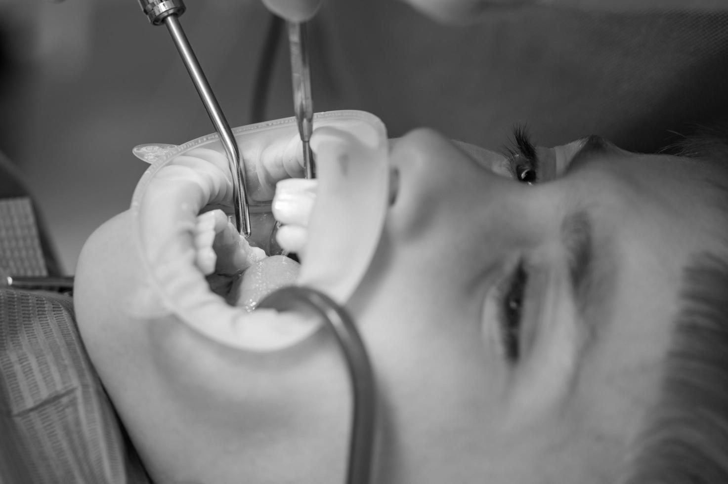 el dentista limpia la caries dental en un niño con un taladro, en la saliva eyectora de la boca del niño. foto