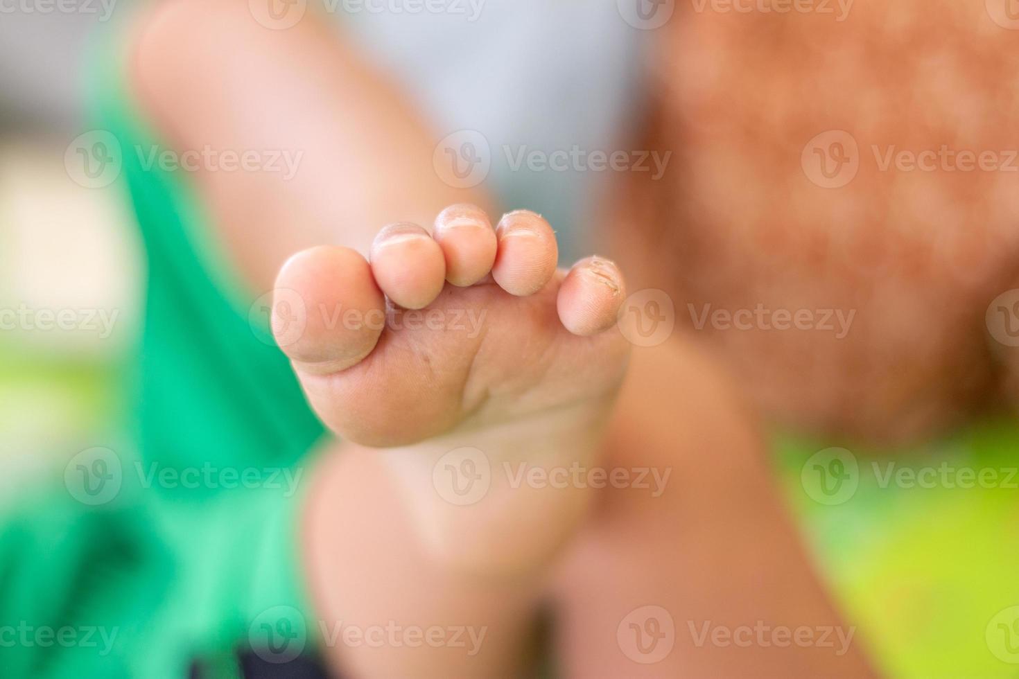 Baby feet and toes have scars on the toes photo