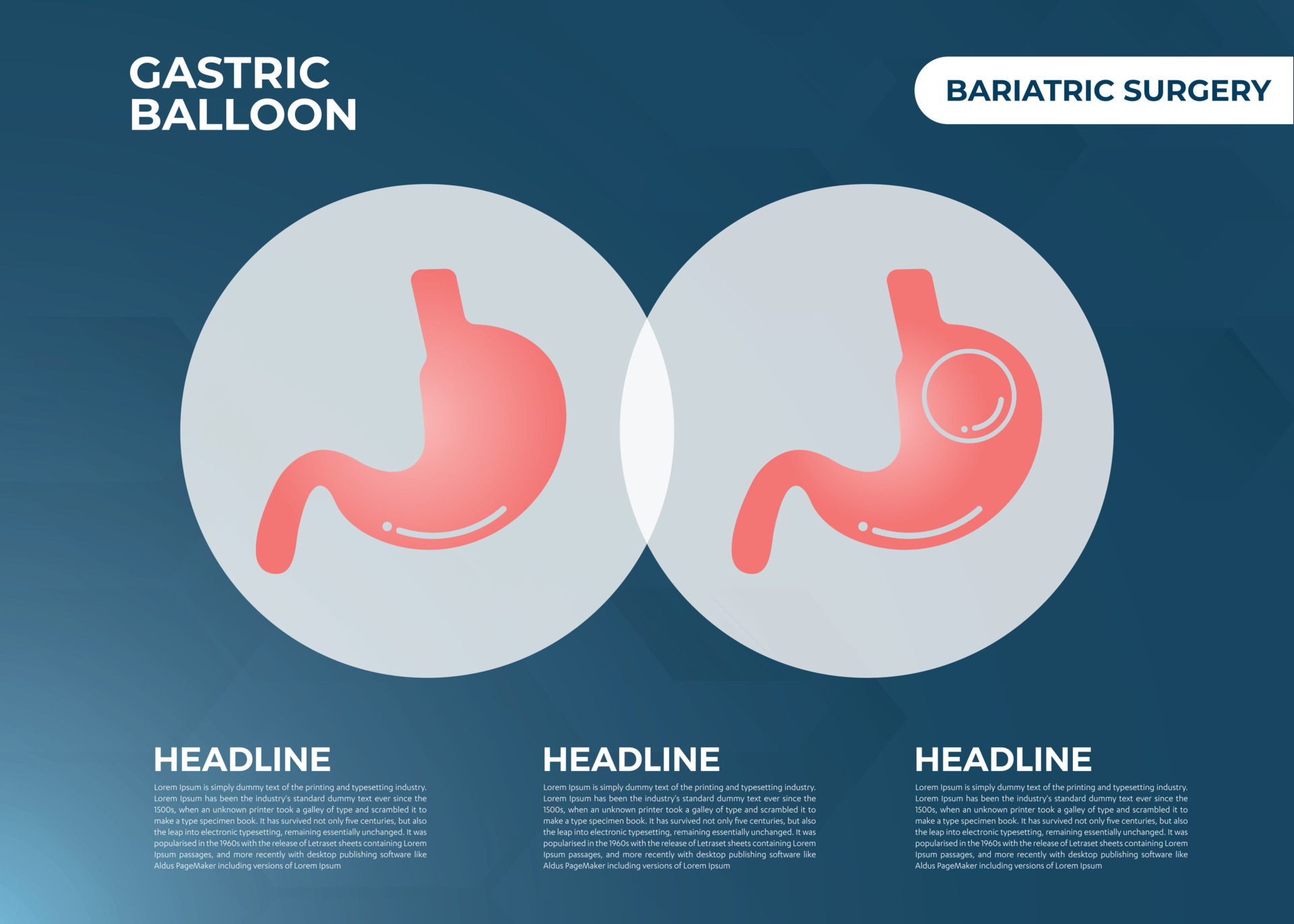 Stomach Endoscopy Gastric Balloon Inside a Stomach weight loss surgery