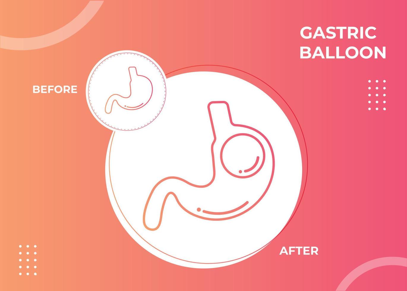endoscopia estomacal balón gástrico dentro de un estómago cirugía de pérdida de peso ilustración vectorial obesidad vector