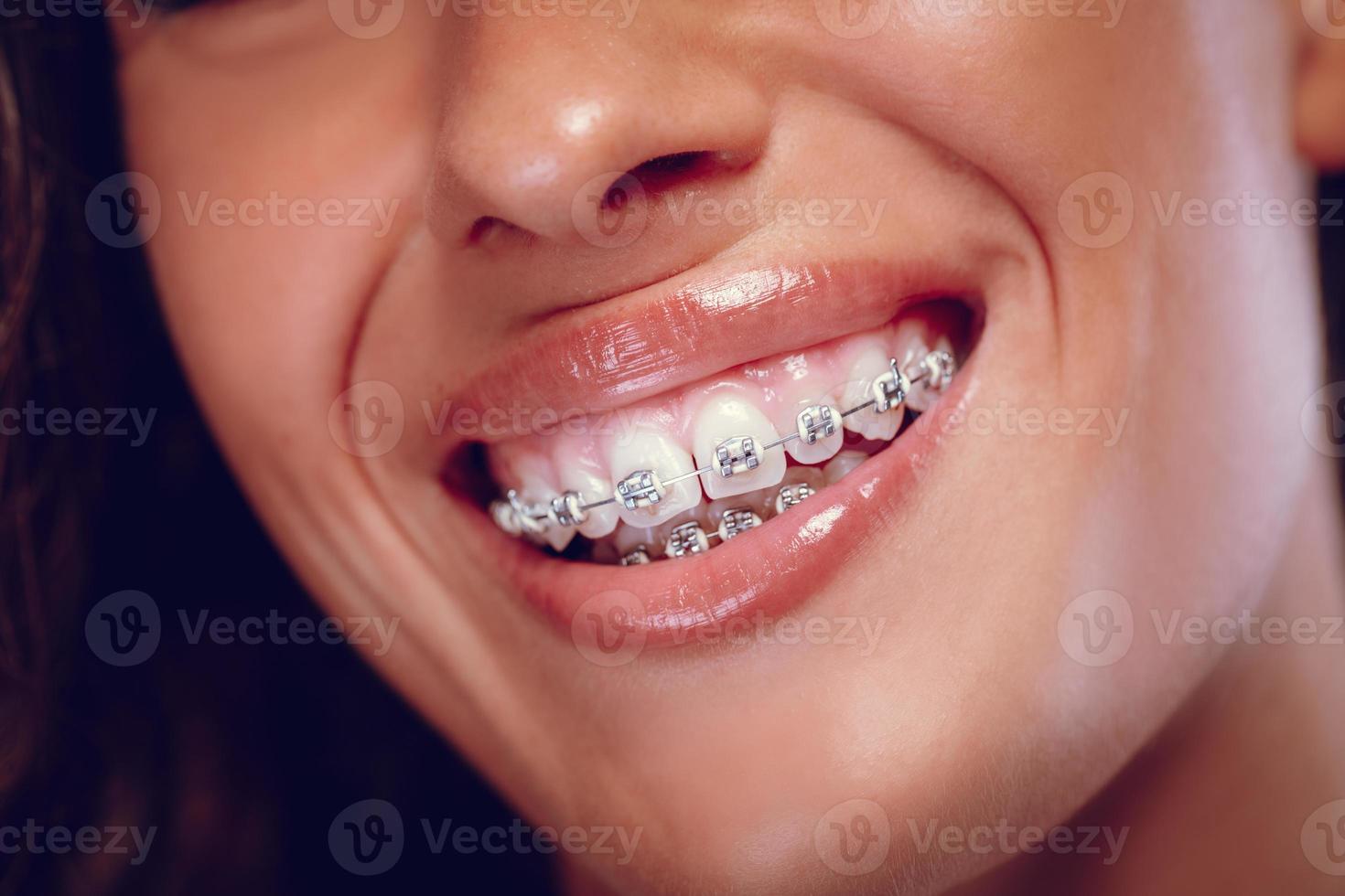 Smile With Braces Too photo