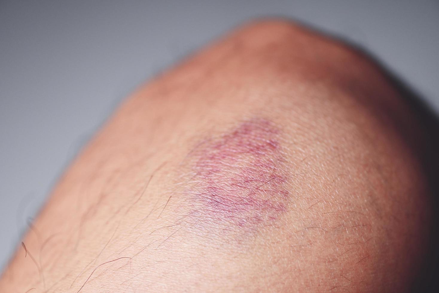 pressure-ulcer-stock-photos-images-and-backgrounds-for-free-download