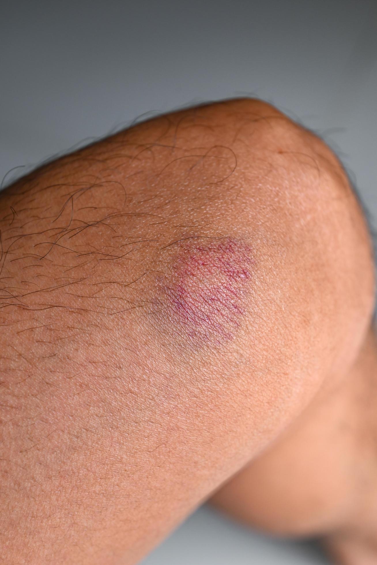 bruised on knee wound bruised on leg caused by sports and bump or