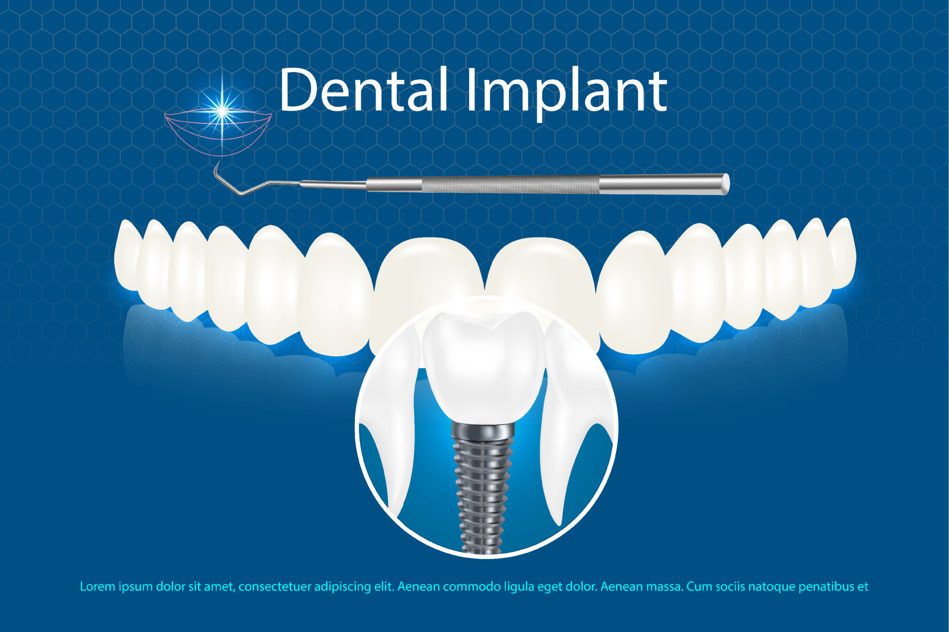 Vector 3d realistic white dental implant on blue background with