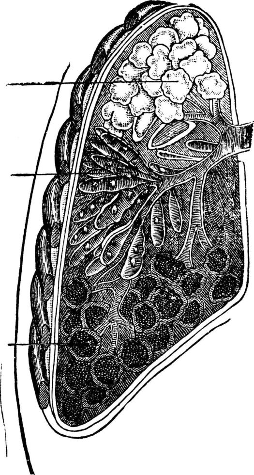 Lung with Pneumonia, vintage illustration vector