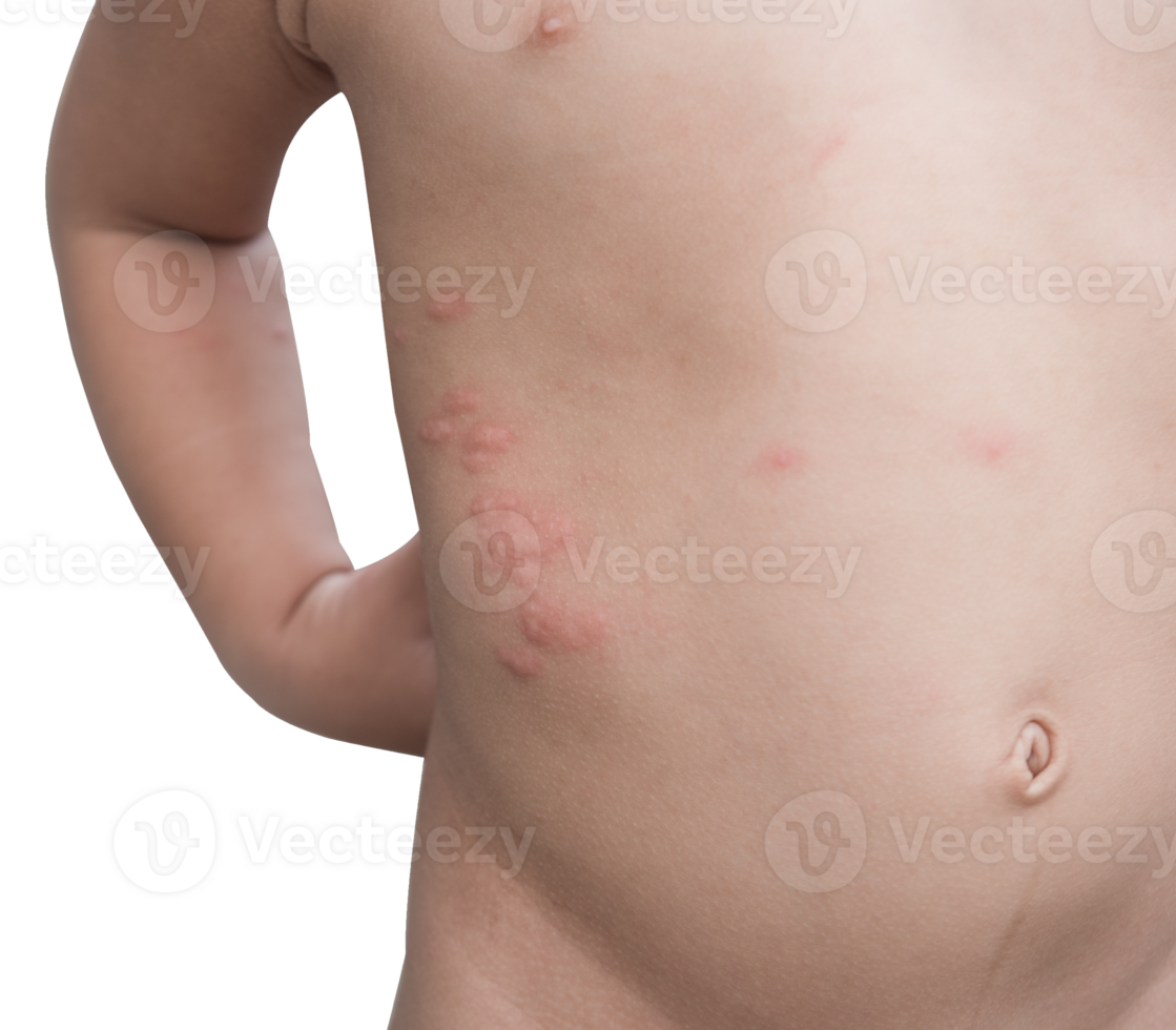 Boy with multiple and insect bites on body isolated png