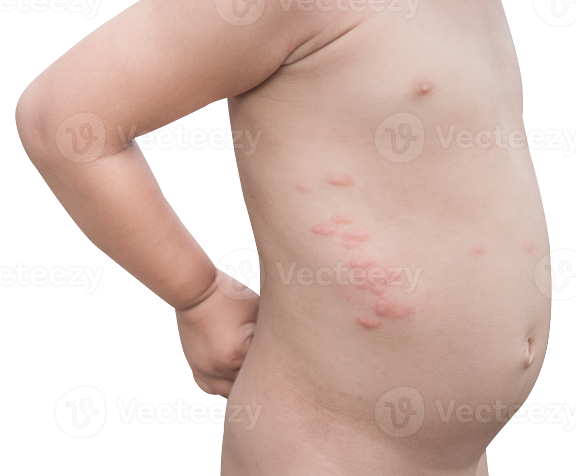 Boy with multiple and insect bites on body isolated png