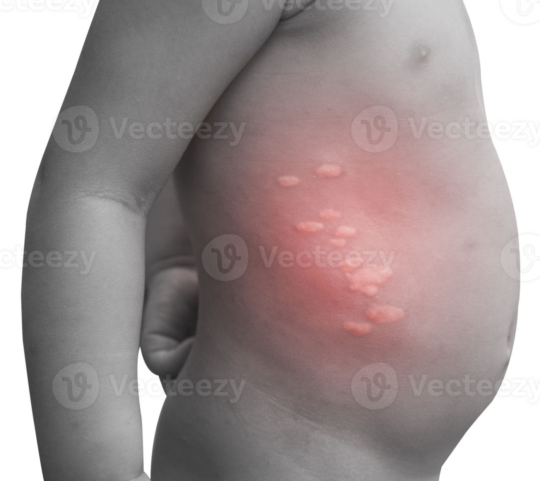 Boy with multiple and insect bites on body isolated png