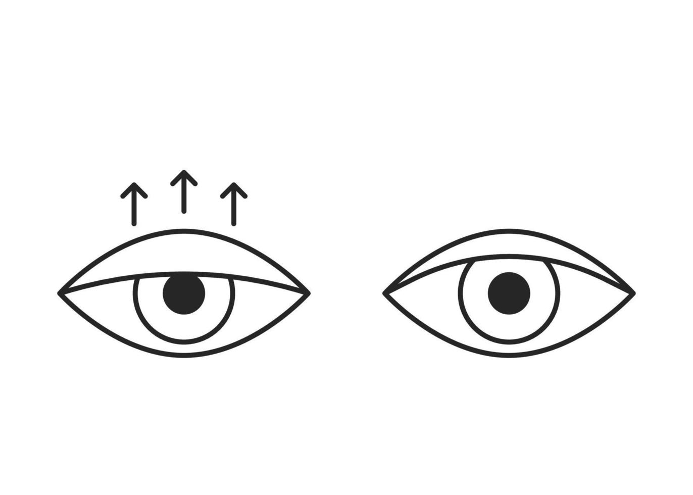 ojo de comparación con ptosis del párpado hacia abajo y párpado sano, icono de línea. blefaroplastia, cirugía de párpados. corrección de la vista estética del ojo. ilustración vectorial vector