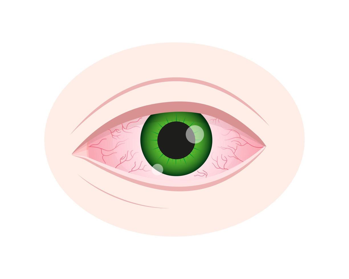 irritación de ojo. globo ocular inyectado en sangre inflamado con conjuntiva roja aislada sobre fondo blanco. síntoma de queratitis, alergia, conjuntivitis, uveítis vector