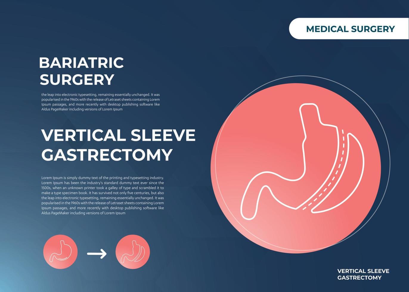 Laparoscopic Sleeve Gastrectomy, Vertical Gastrectomy, Weight loss surgery Vector Illustration