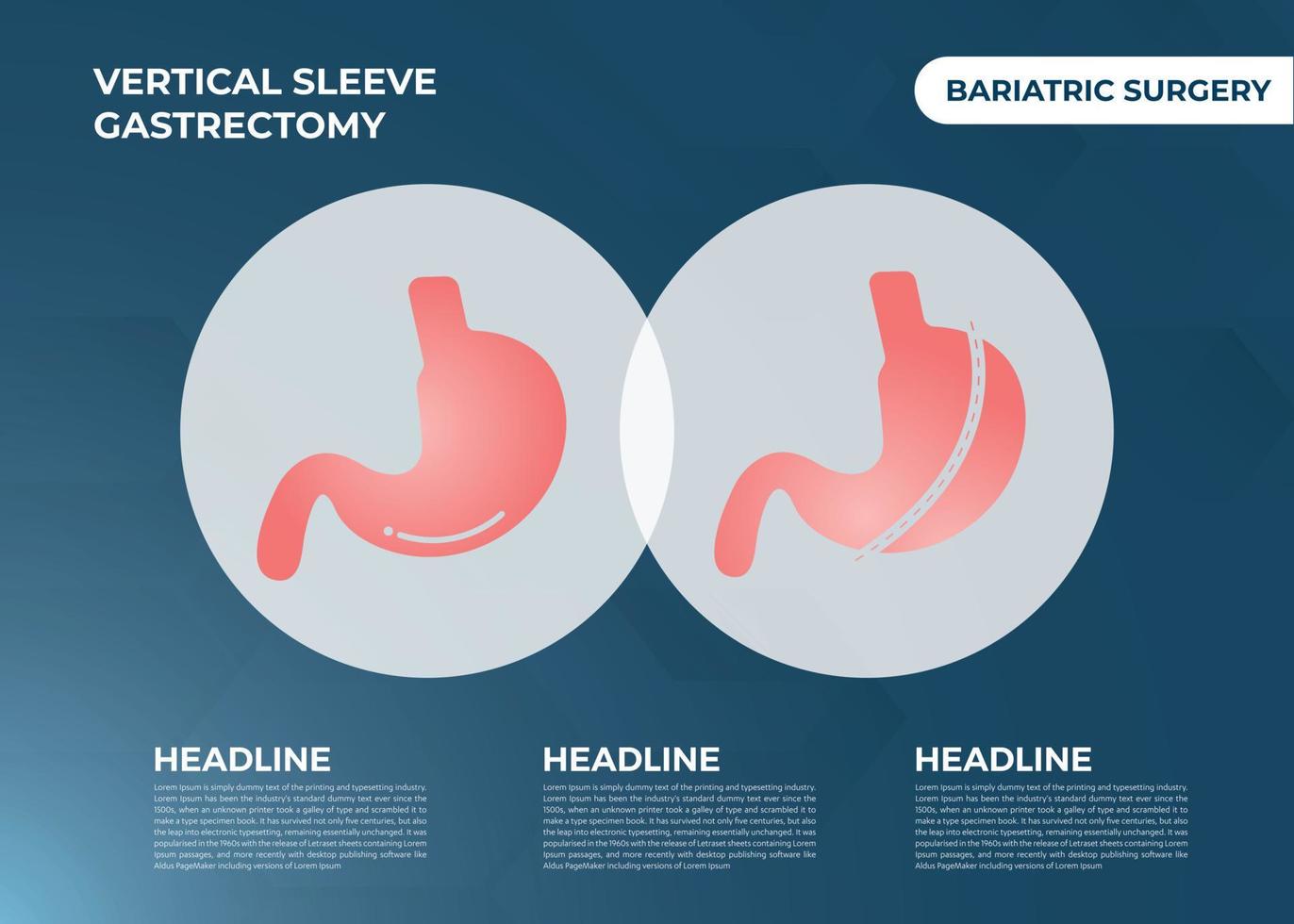 Laparoscopic Sleeve Gastrectomy, Vertical Gastrectomy, Weight loss surgery Vector Illustration of Stomach reduction surgery