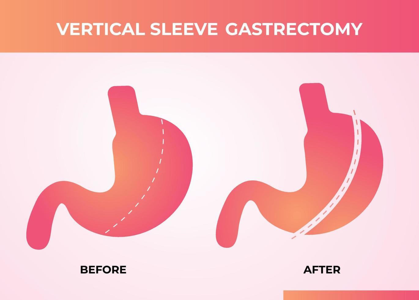 Laparoscopic Sleeve Gastrectomy, Vertical Gastrectomy, Weight loss surgery Vector Illustration of Stomach reduction surgery