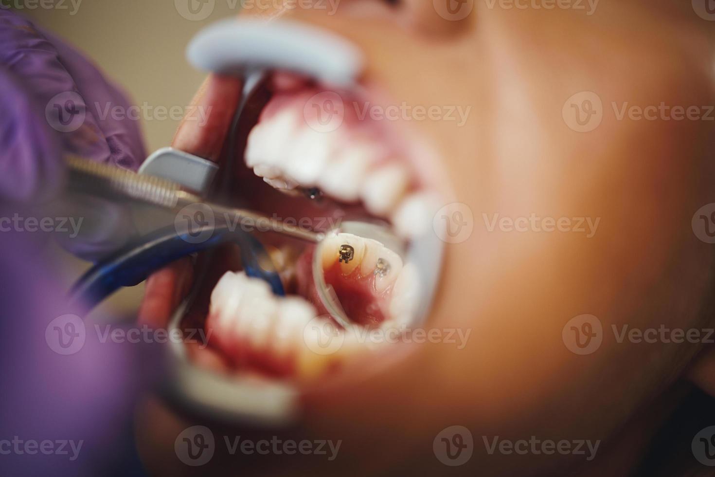 Lingual Braces Checkup photo