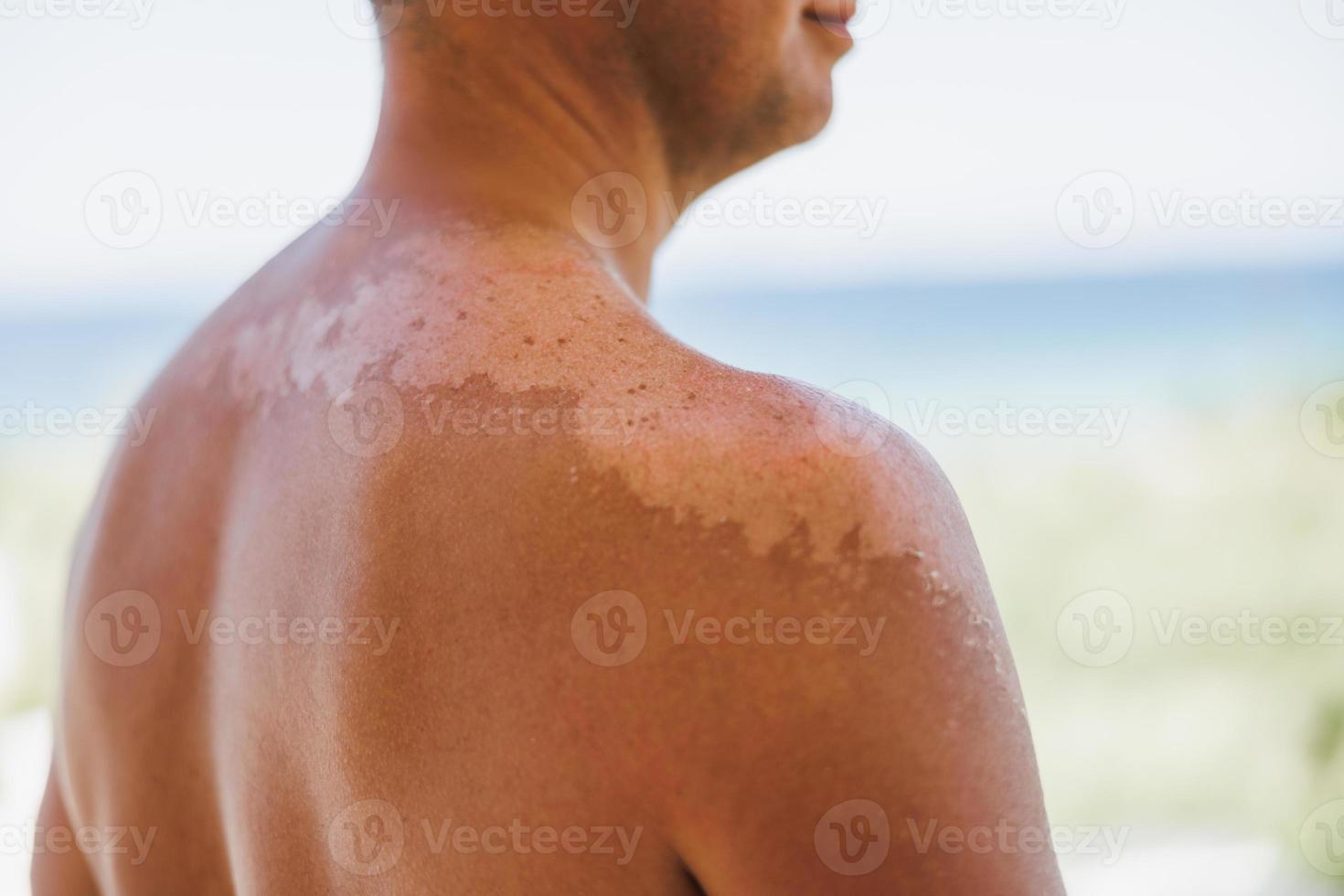 primer plano de un hombro rojo y la espalda de un hombre con la piel quemada por el sol foto