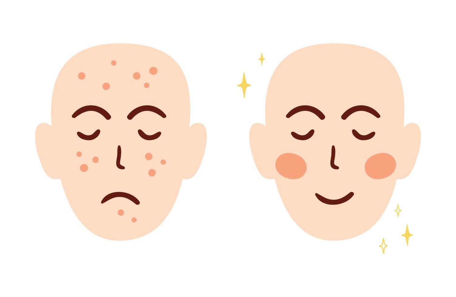 concepto de tratamiento facial de acné con dos caras diferentes antes y después. problema de la piel del acné. cicatrices de acné. elementos de carácter de marca cosmética anti acné aislados en blanco. ilustración vectorial de dibujos animados. vector