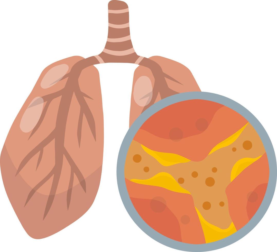 Lung disease. Blockage of canal. Mucus in alveoli. Breathing problems. Magnified view under microscope. Bronchi and bronchitis. Flat Educational medical material. vector