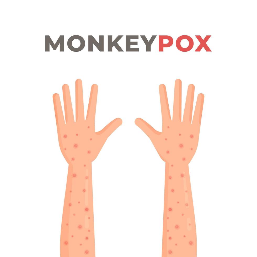 Symptoms of monkeypox. Vector illustration of rash on hands. Monkeypox epidemic in Africa and Spain. Infection.