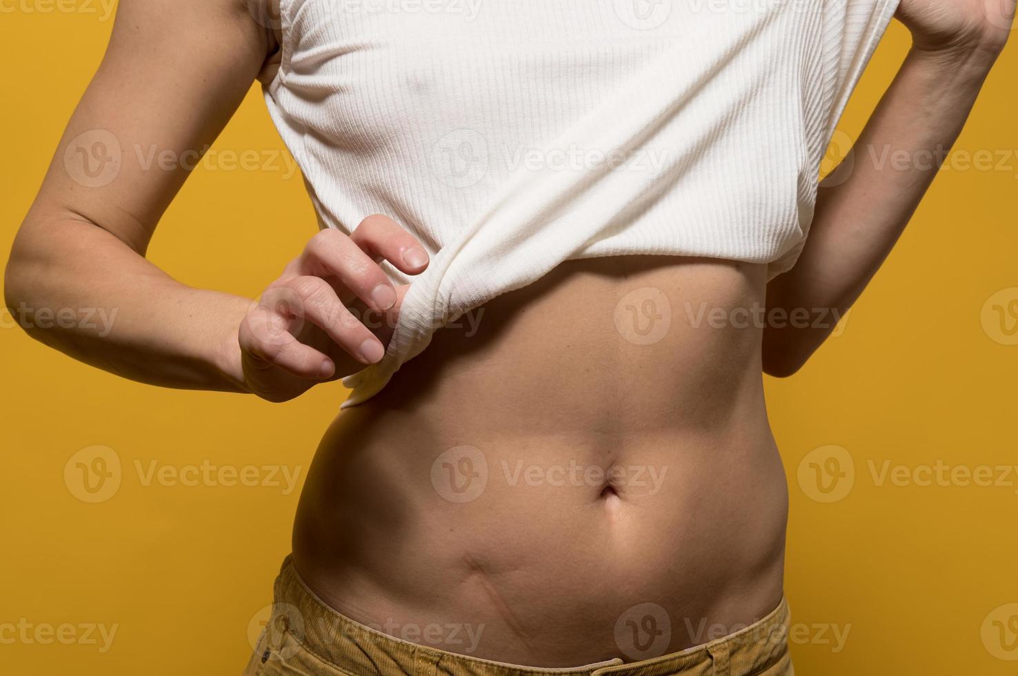 Woman bared her belly with a scar obtained as a result of an an appendectomy, she is not ashamed of her flaw and feels confident. photo