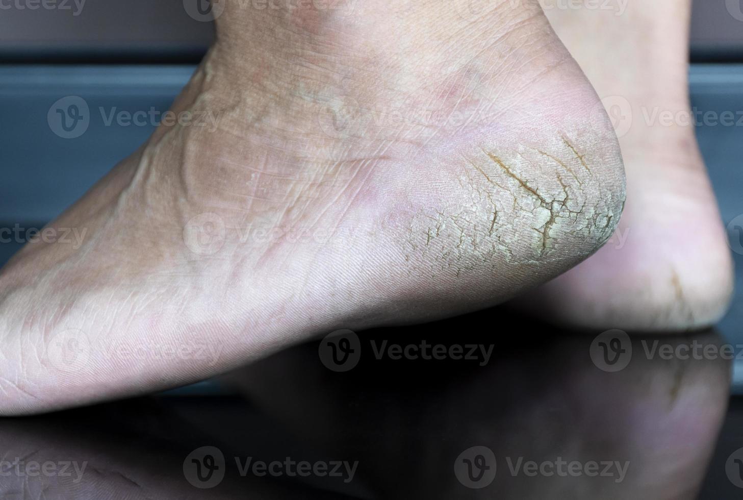 Close up cracked heel further deep cracks and dry flaky skin 14024821