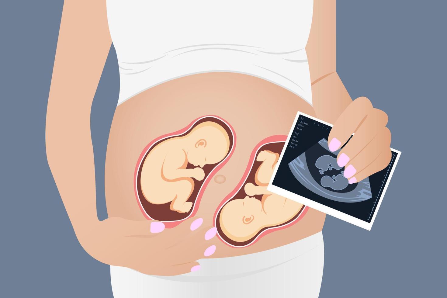 mujer embarazada con mellizos en el útero. ilustración vectorial vector