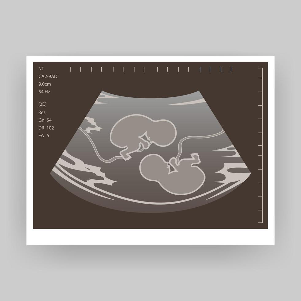 ultrasonido de un gemelo en el útero. ilustración vectorial en escala de grises. una imagen de ultrasonido de un bebé. Medicina y salud del feto de gemelos. ecografía embrionaria realista vector