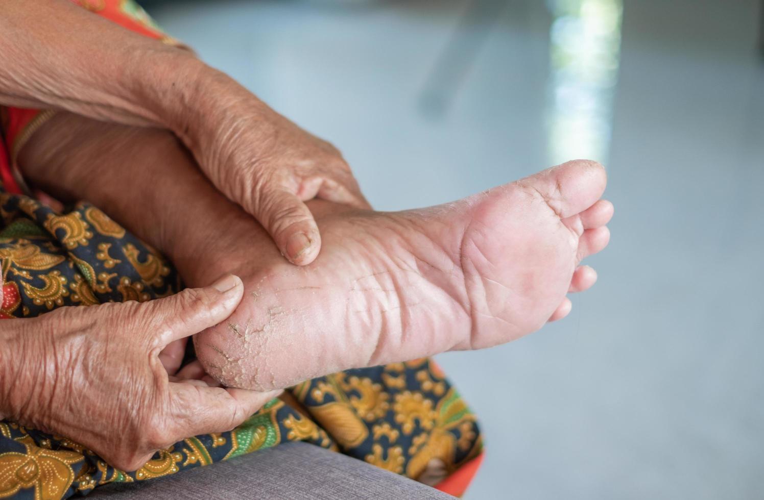 cracked feet, dry skin, close up asia senior woman cracked feet,The heels of an Asian senoir woman who shifts from walking down to the weight of the feet can be treated with weight loss exercises photo