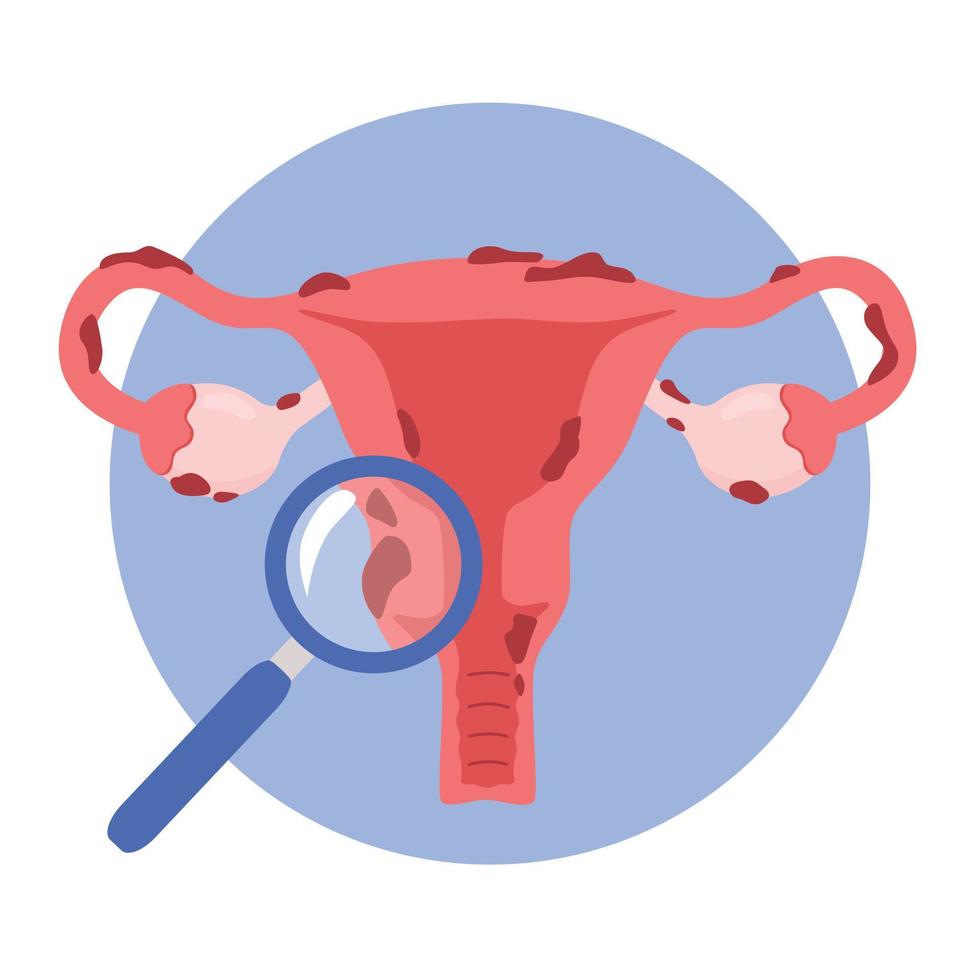 Illustration of the uterus and endometriosis. Womens diseases, gynecological examination and prevention of womens health. vector