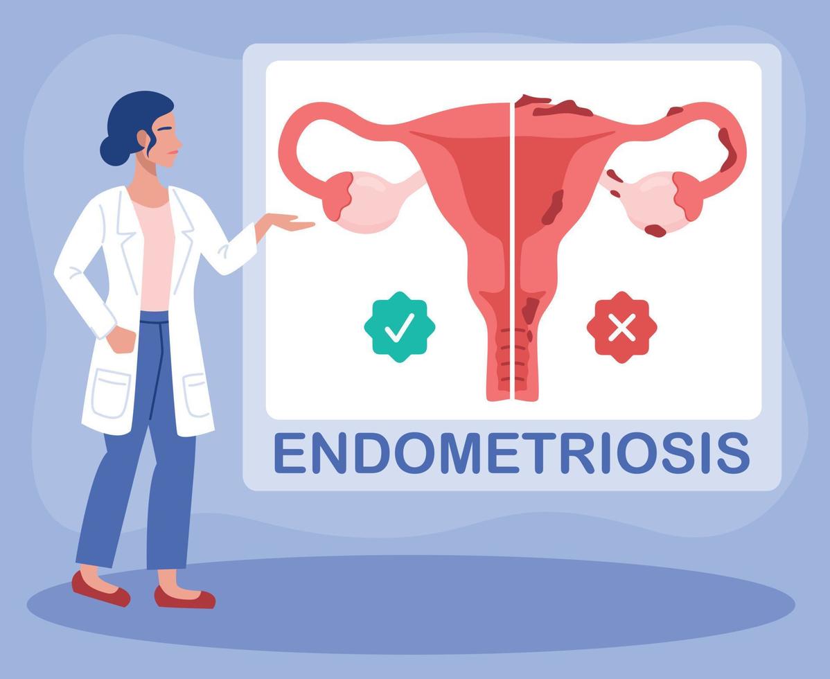 Doctor gynecologist talks about endometriosis, uterus and womens health. vector