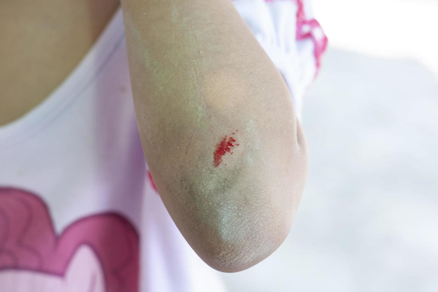 heridas en el brazo de un niño debido a un accidente al jugar. foto