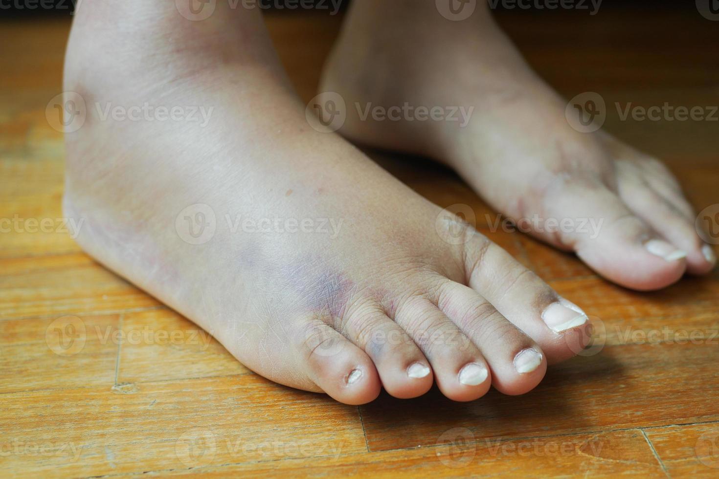 close up of women feet with swelling photo
