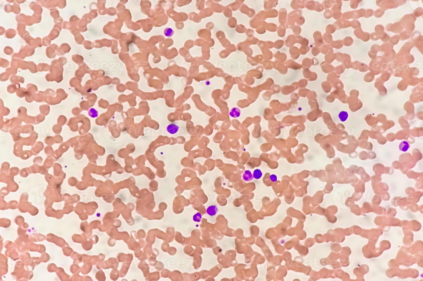 Photomicrograph of hematological slide showing monocytosis. Abnormal monocyte. photo