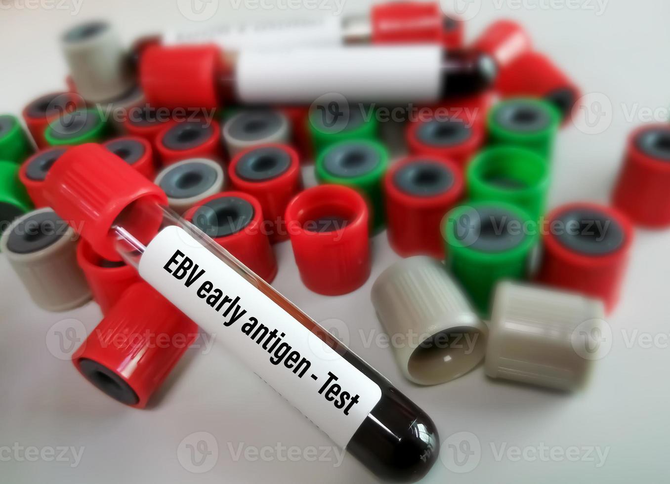 Blood sample isolated for EBV early antigen test. 14261303 Stock Photo