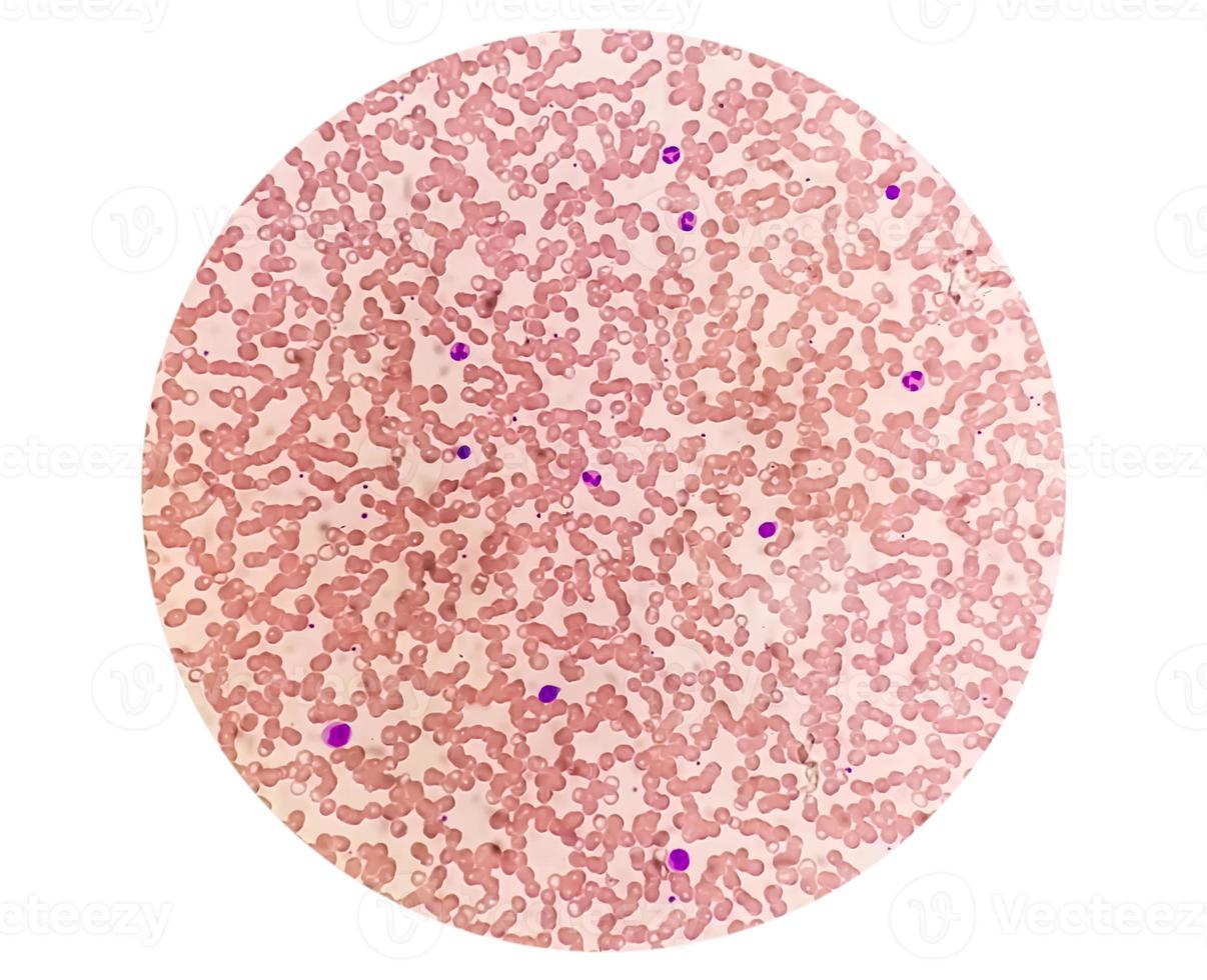 Photomicrograph of hematological slide showing monocytosis. Abnormal monocyte. photo