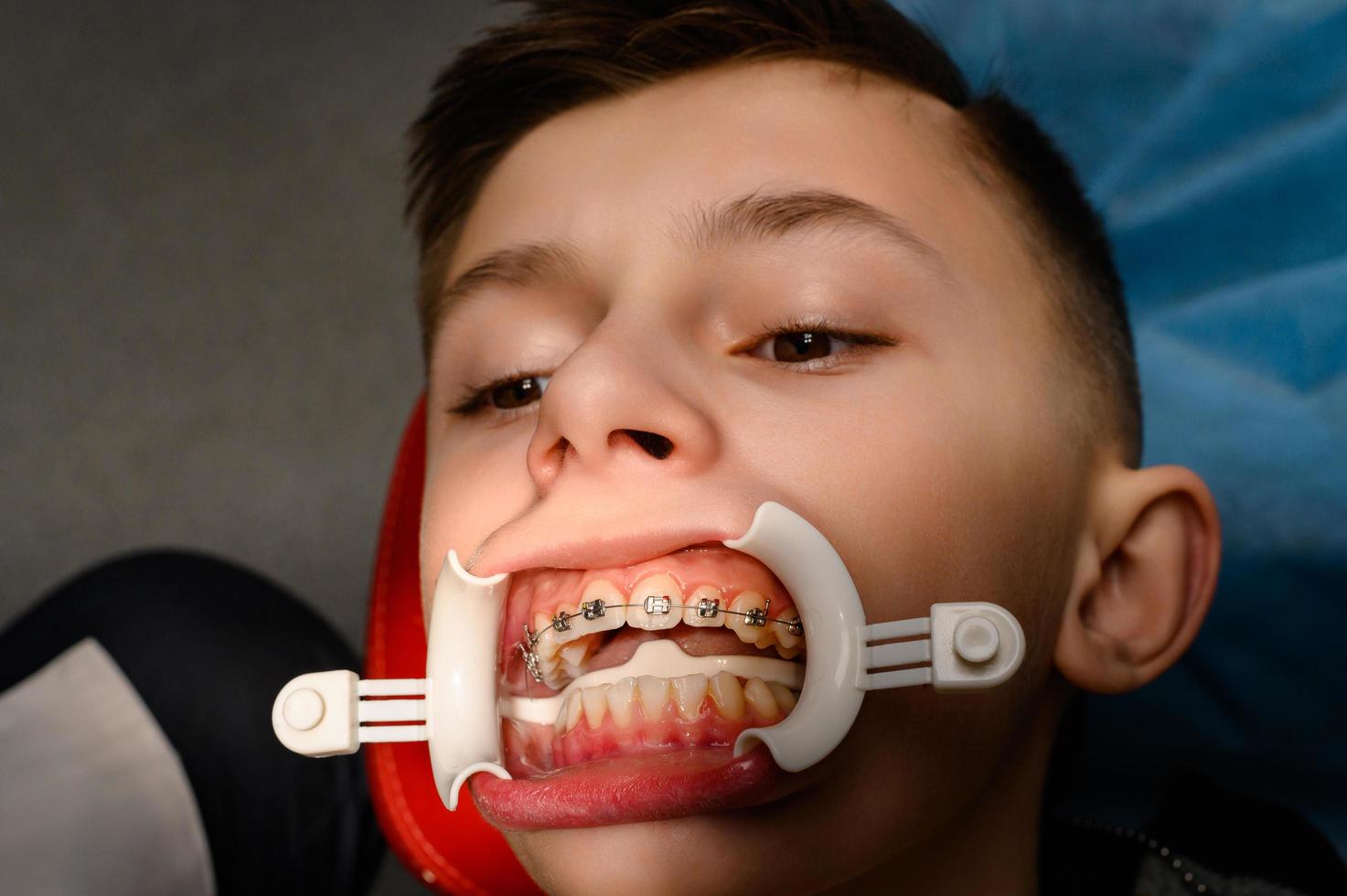 visita al ortodoncista, instalación de frenos en los dientes superiores, retractor blanco en los labios del niño. foto