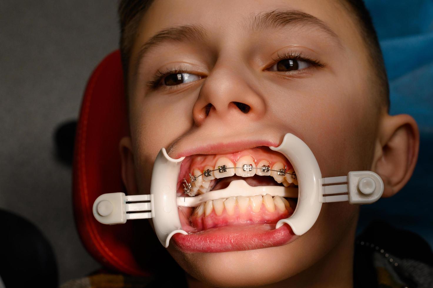 Visit to the orthodontist, installation of braces on the upper teeth