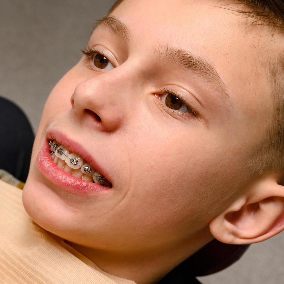 stretching rubber bands on braces. photo