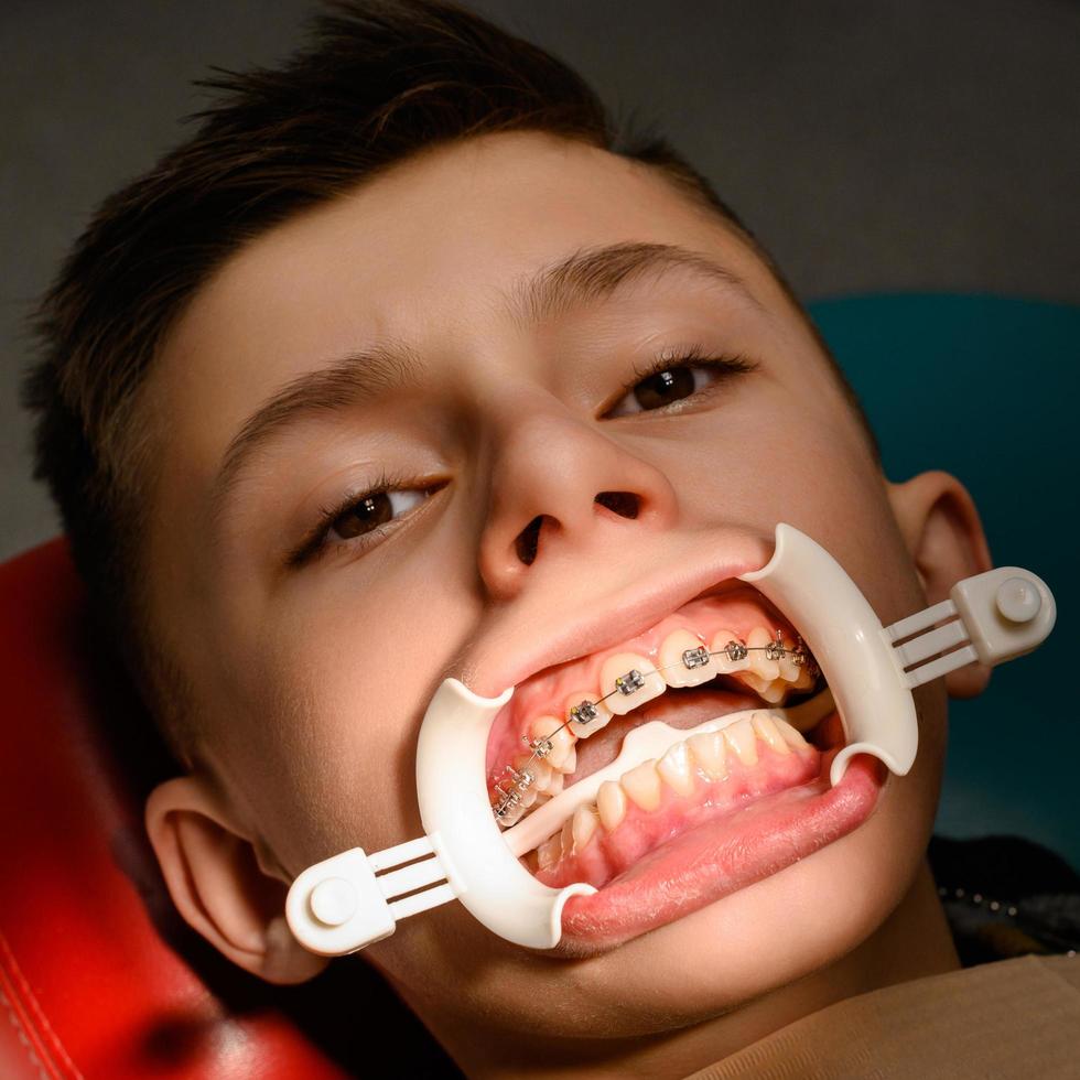 visita al ortodoncista, instalación de frenos en los dientes superiores, retractor blanco en los labios del niño. foto