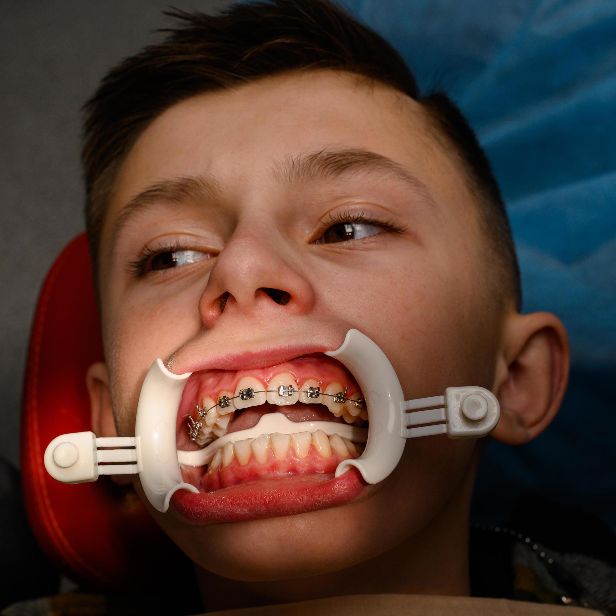 Visit to the orthodontist, installation of braces on the upper teeth