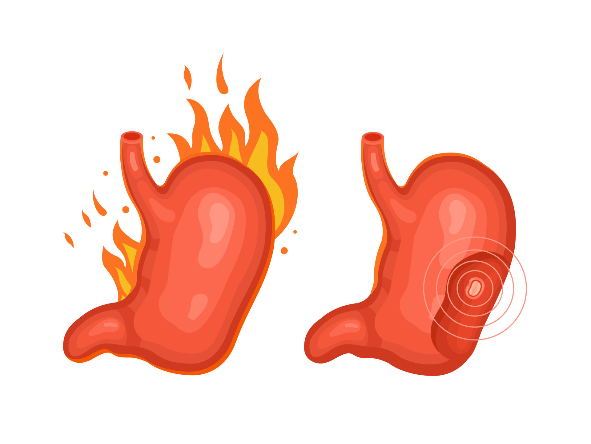 Diseases of the human stomach. Heartburn and ulcer. Internal organ, anatomy, medicine. Vector