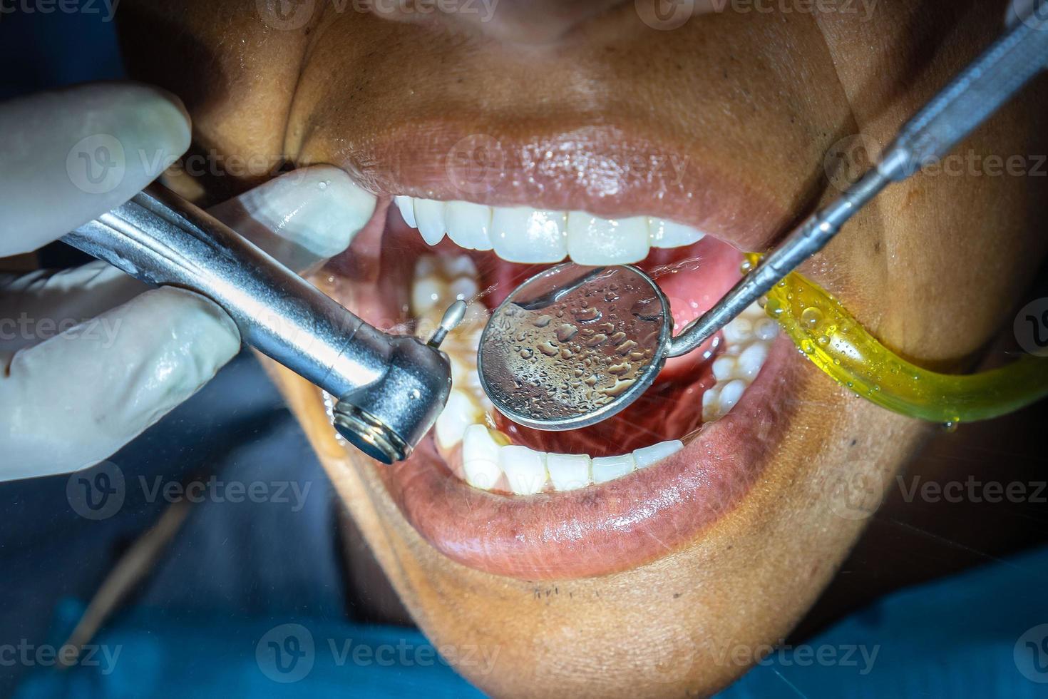 Macro photograph of a young man undergoing dental checkup. photo