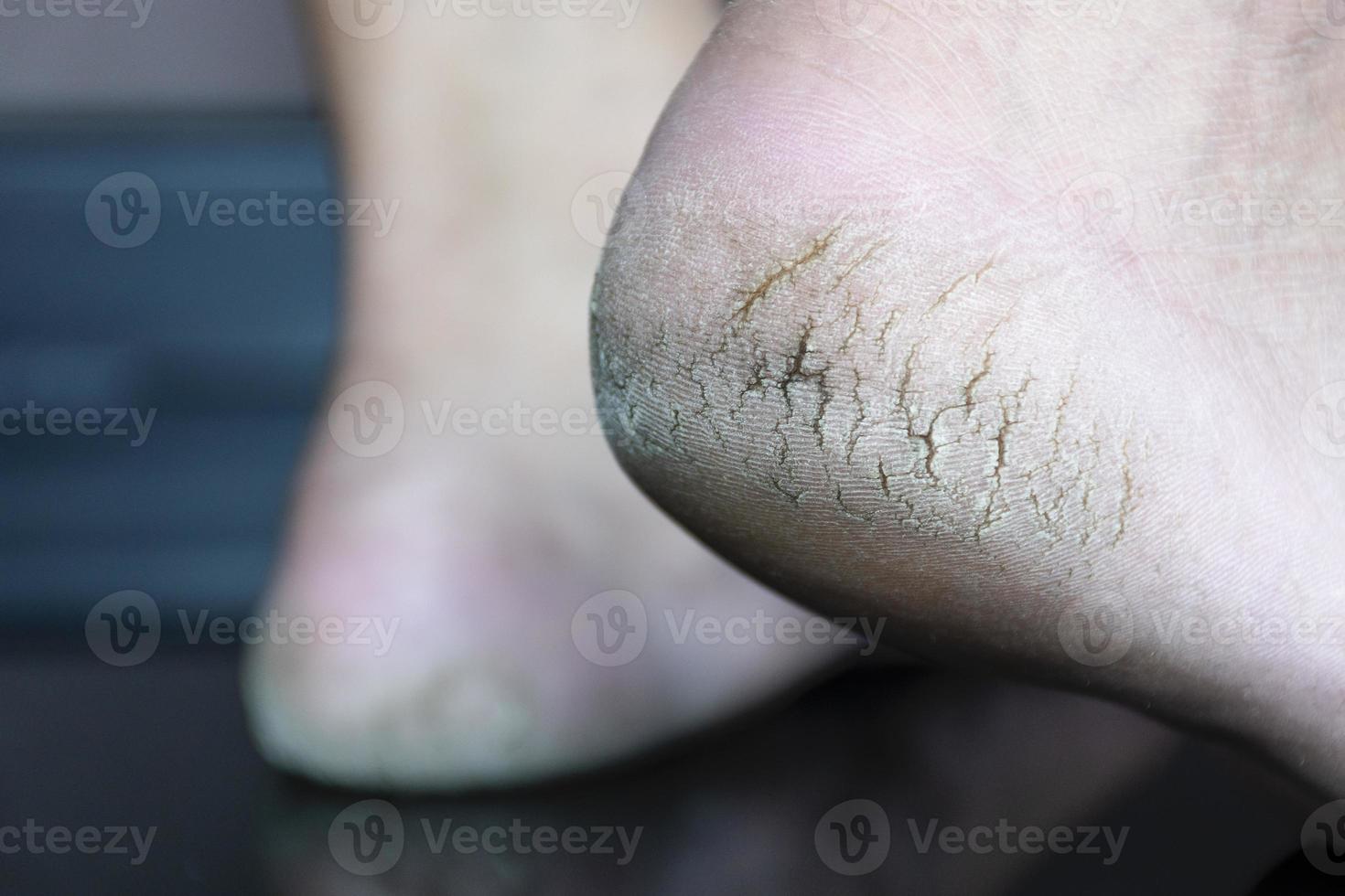 Close up cracked heel further deep cracks and dry flaky skin photo