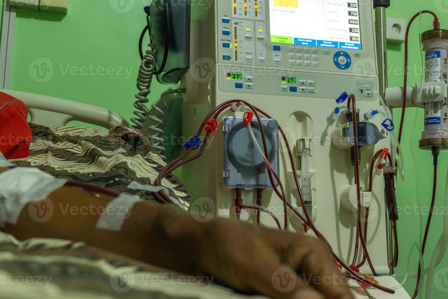 Dialysis machine. dialysis system. hemodialysis in patient at hospital
