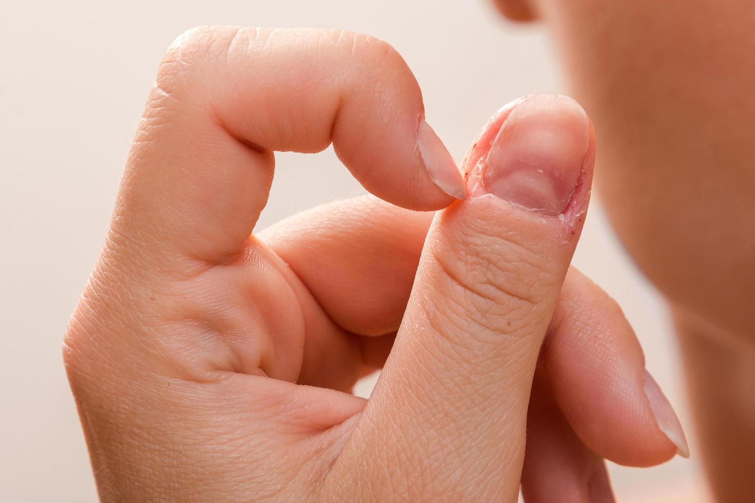 Closeup of injured female finger after biting nails photo