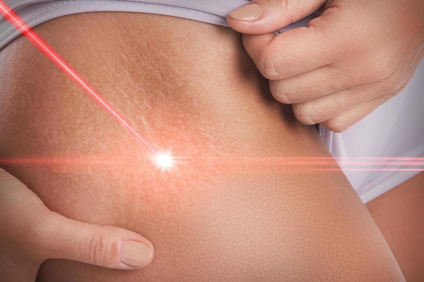 Stretch marks during laser removal session treatment photo