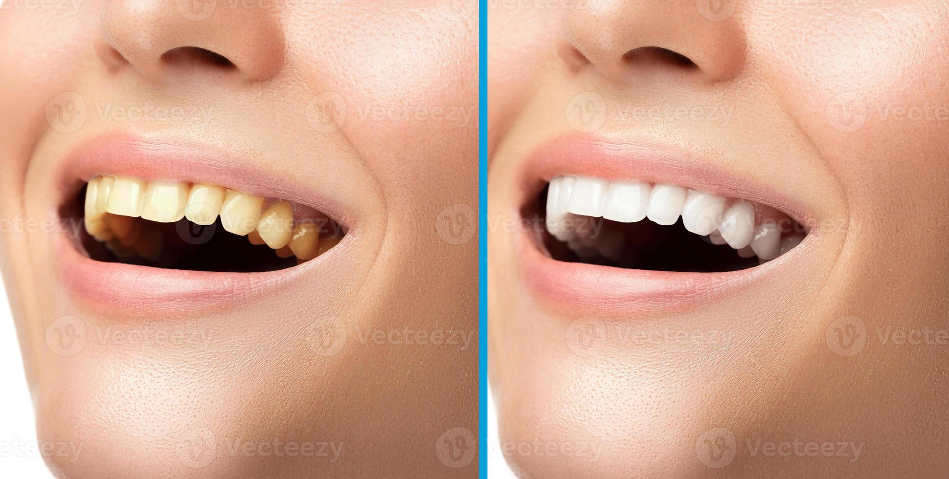 resultado después del tratamiento de blanqueamiento dental en la clínica dental profesional. foto